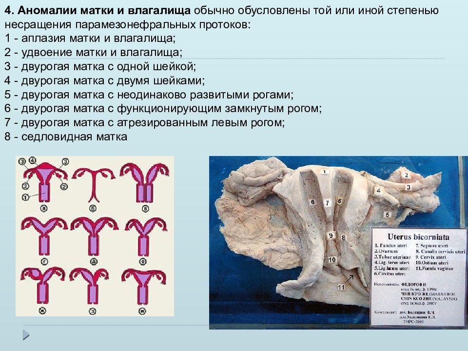 Аномалии Влагалища Фото