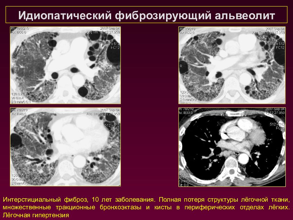 Презентация идиопатический фиброзирующий альвеолит