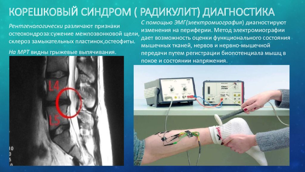 Корешковый синдром шейного отдела лечение