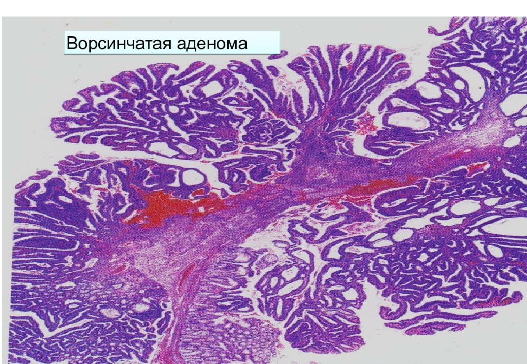 Тубулярно ворсинчатая аденома с интраэпителиальной неоплазией. Ворсинчатая аденома гистология. Ворсинчатый полип гистология. Тубулярная аденокарцинома. Тубуло-ворсинчатая аденома сигмовидной кишки.