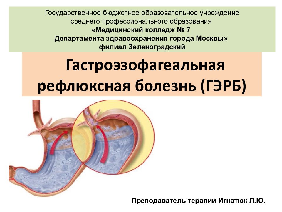 Г е р б. Гастро-рефлюксная болезнь. Гастроэзофагеальная рефлюксная Гастроэзофагеальная болезнь. Гастроэзофагеальная рефлюксная болезнь (ГЭРБ). Презентация на тему Гастроэзофагеальная рефлюксная болезнь.