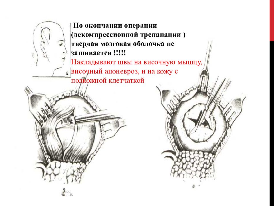 Завершение операции. Трепанация черепа мозговой оболочки. Трепанация это топографическая анатомия. Шов твердой мозговой оболочки.