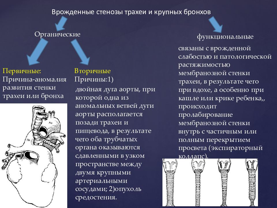 Пороки Развития Трахеи