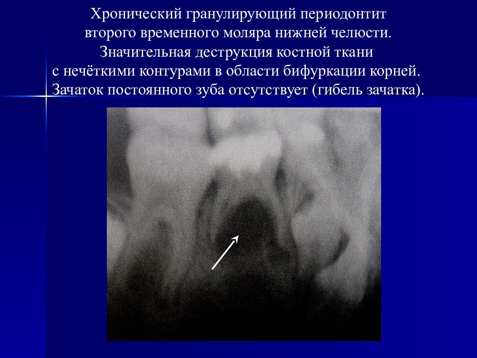 Хронический фиброзный периодонтит лечение. Периодонтит фиброзный гранулематозный гранулирующий. Гранулирующий периодонтит рентгенограмма. K04.5 хронический апикальный периодонтит. Гранулирующий периодонтит ЭОД.