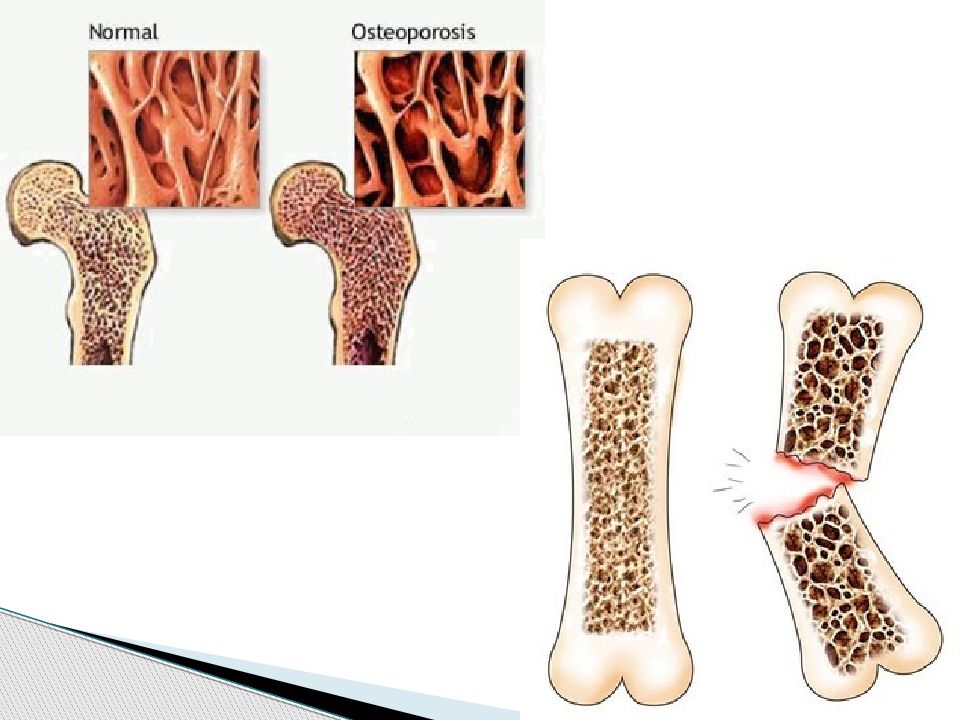 Разрушение костей. Остеопороз губчатого вещества. Остеопороз и ревматоидный артрит. Диффузный сенильный остеопороз.