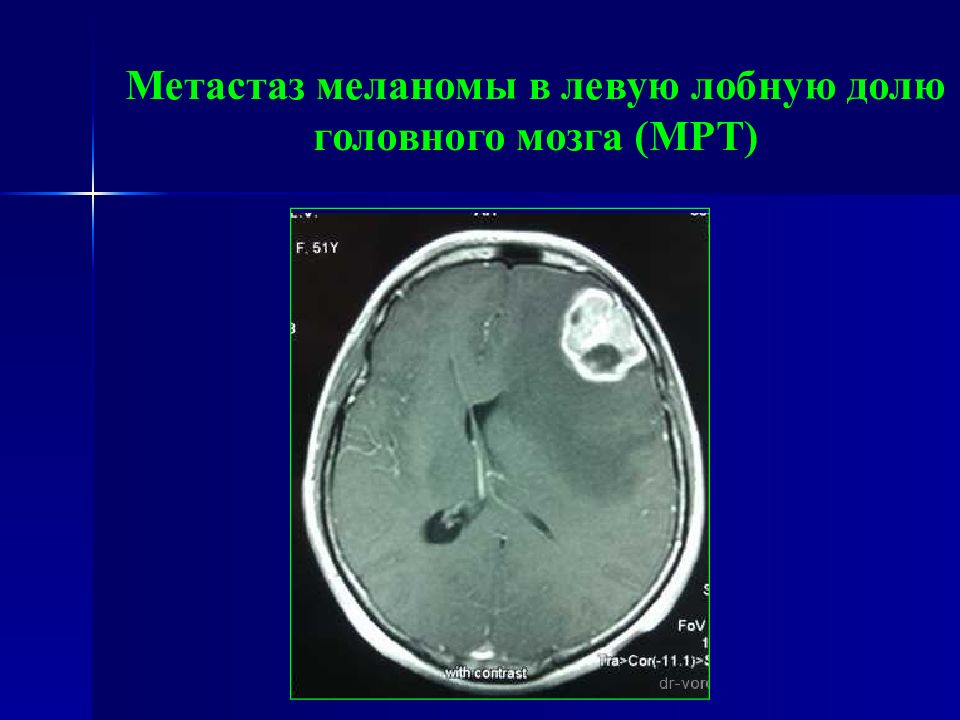 Метастазы в мозг прогноз. Метастазы меланомы в головной мозг кт. Метастазы меланомы в головной мозг мрт. Метастазы головного мозга кт.