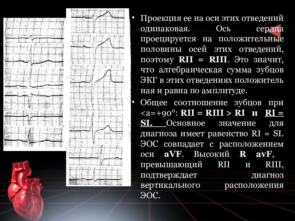 Эос экг что значит. Электрическая ось на ЭКГ. Электрическая ось s1 q3. Трепетание предсердий ЭОС ЭКГ. Электрическая ось типа q1 s3.