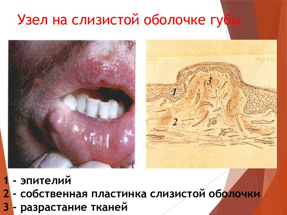 Узел на слизистой оболочке губы