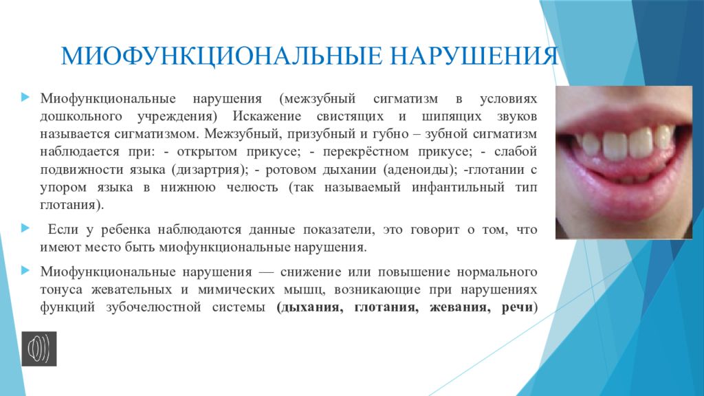 Материал нарушения. Межзубный сигматизм. Миофункциональный нарушения. Межзубный сигматизм свистящих. Пластинка при межзубном сигматизме.