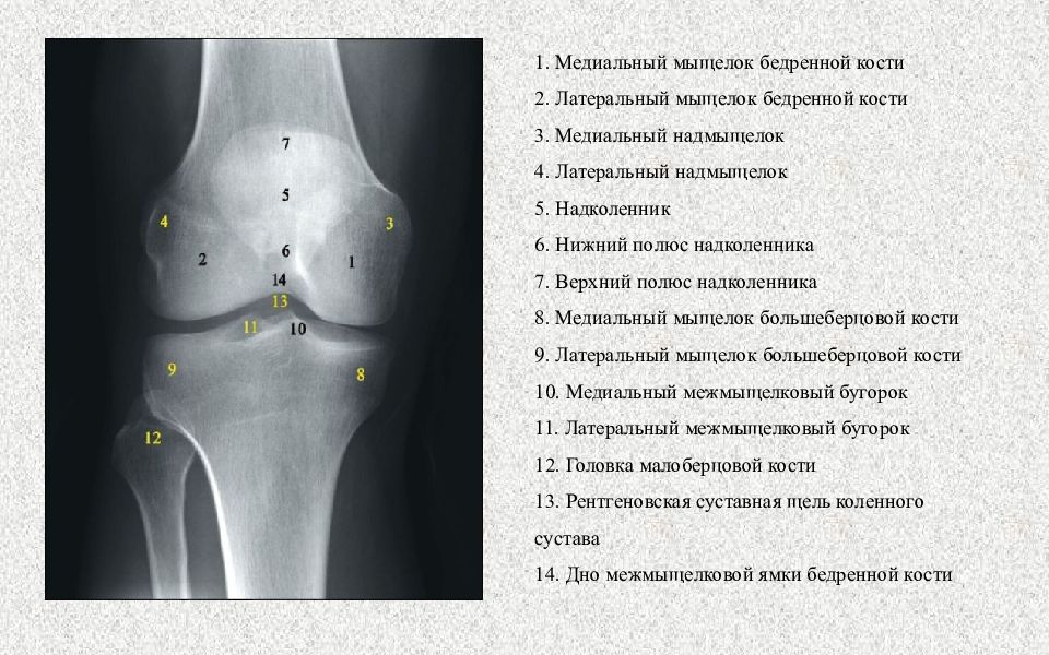 Мыщелок большеберцовой кости фото медиальный