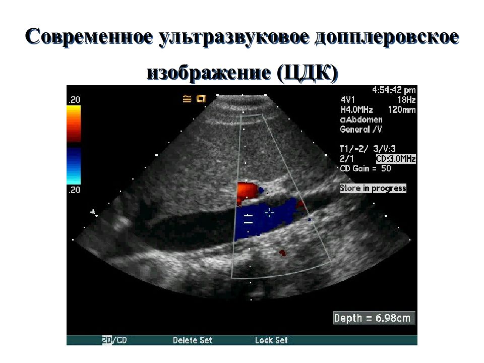 Узи с цдк брюшная. Цветное допплеровское картирование (ЦДК). Цветовое допплеровское картирование ЦДК. ЦДК В УЗИ. ЦДК В гинекологии что это.
