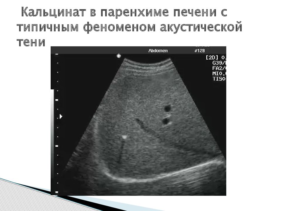 Кальцинаты предстательной железы что это такое