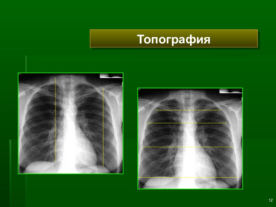 Лучевая диагностика заболеваний легких презентация