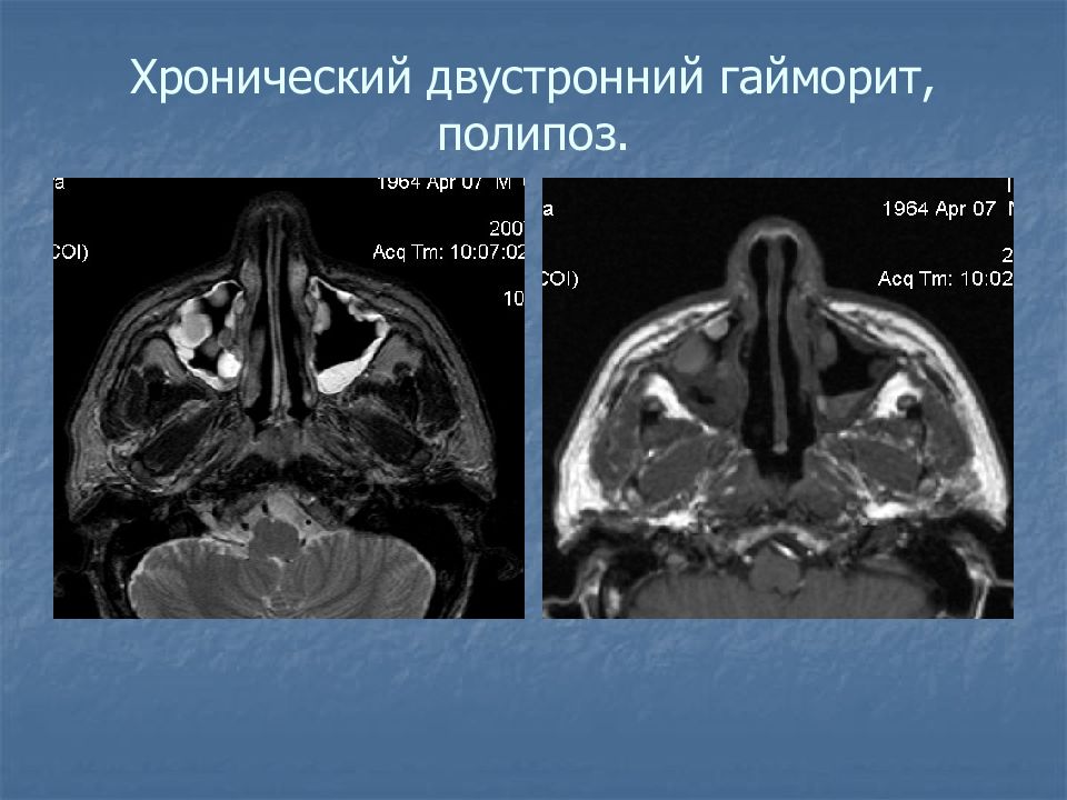 Мрт лобня. Мрт носовых пазух при гайморите.