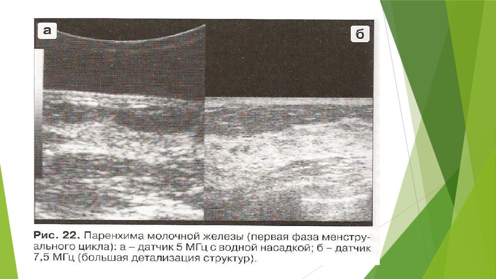 На какой день делать узи молочной железы. УЗИ молочных желез техника проведения. Методика проведения УЗИ молочной железы. Схема молочной железы УЗИ. УЗИ слои строение молочной железы.