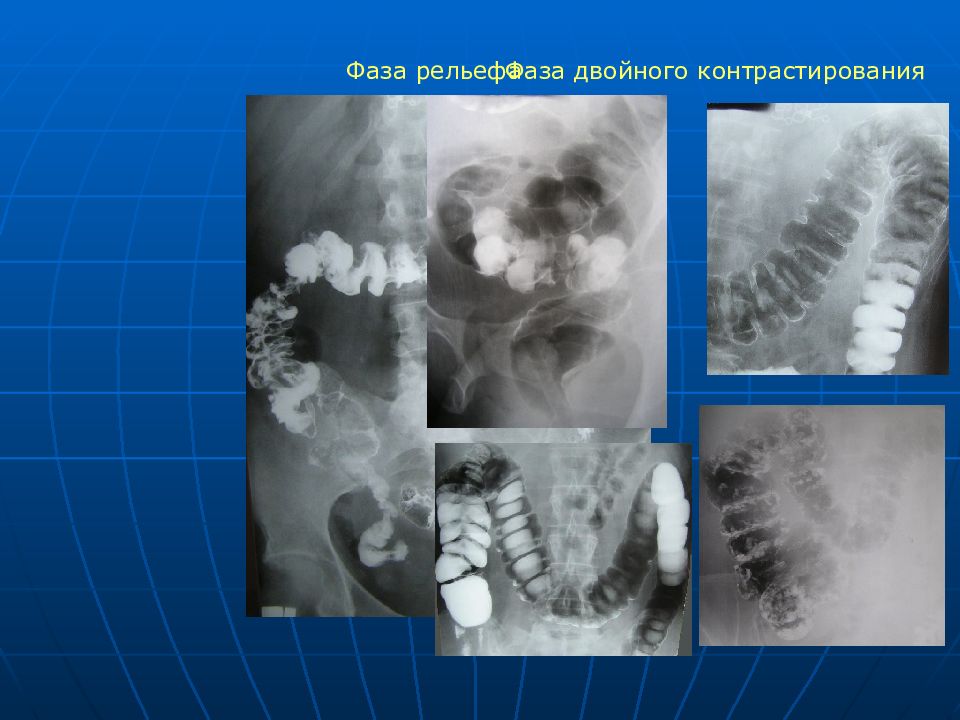 Лучевая диагностика заболеваний жкт презентация