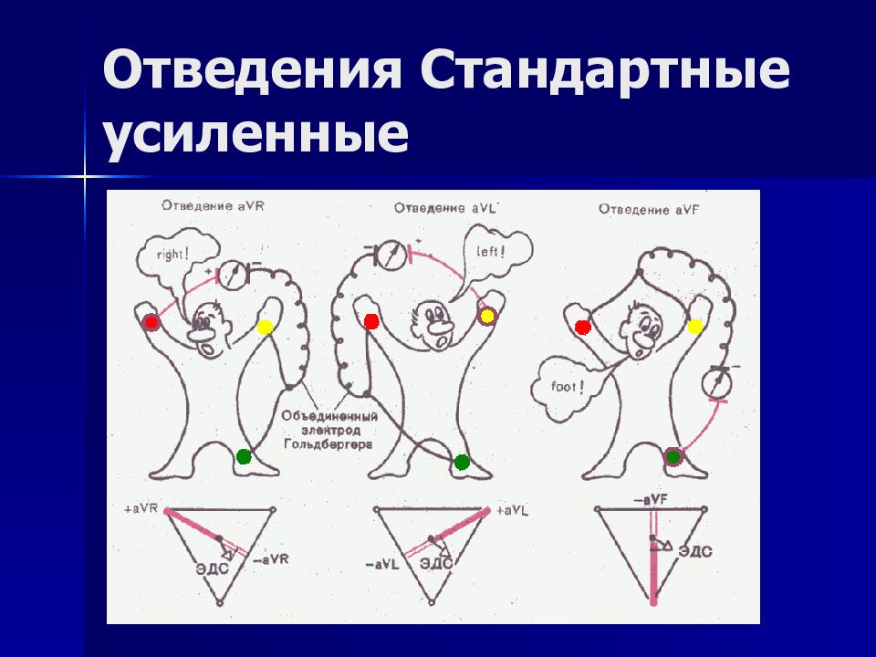 Усиленные отведения экг схема