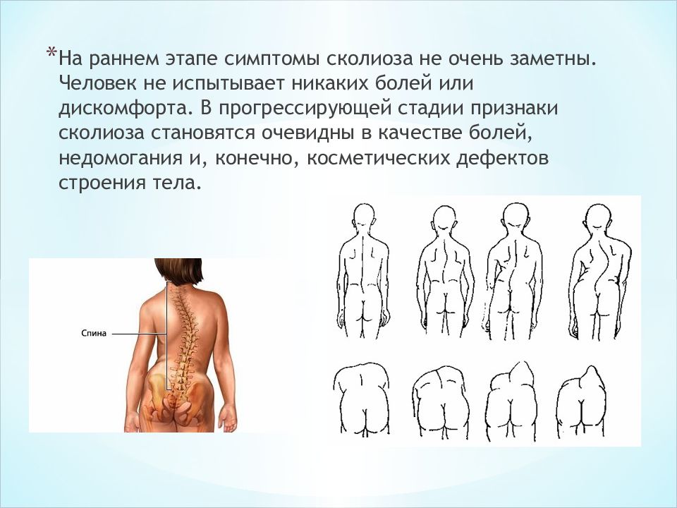 Исследовательский проект сколиоз