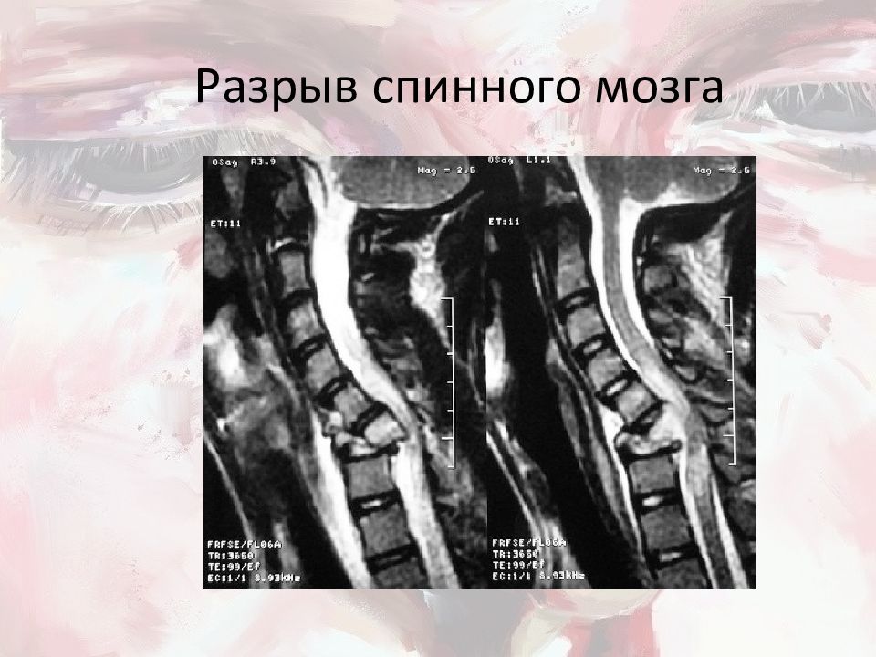 Травмы головного и спинного мозга презентация неврология