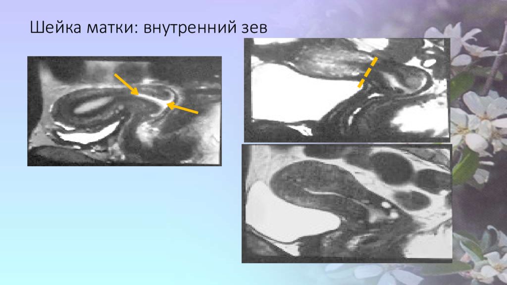 Зев шейки. Шейка матки внутренний зев. Внутренний зев шейки матки сомкнут. Внутренний зев цервикального канала открывается. Расширение маточного зева.