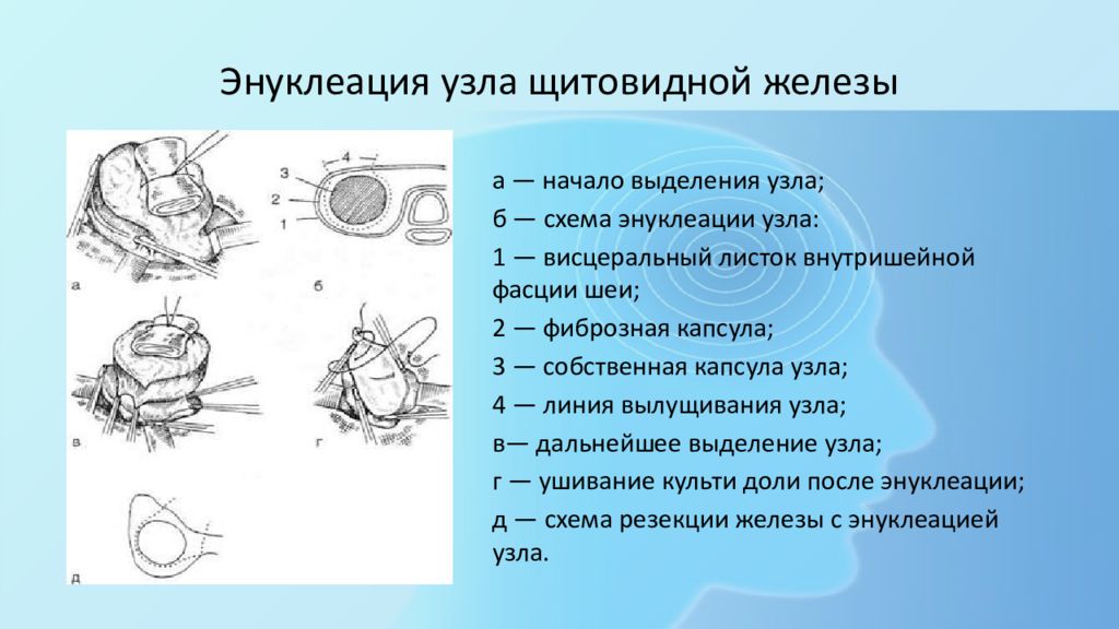 Какие узлы щитовидной железы. Энуклеация щитовидной железы. Энуклеация-резекция щитовидной железы.