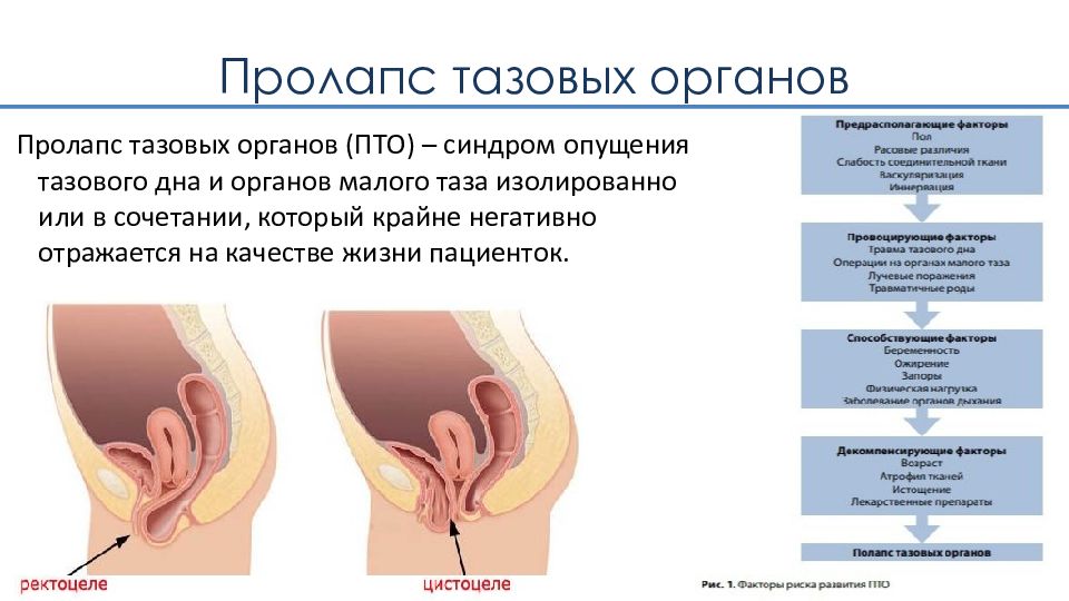 Пролапс тазовых органов презентация