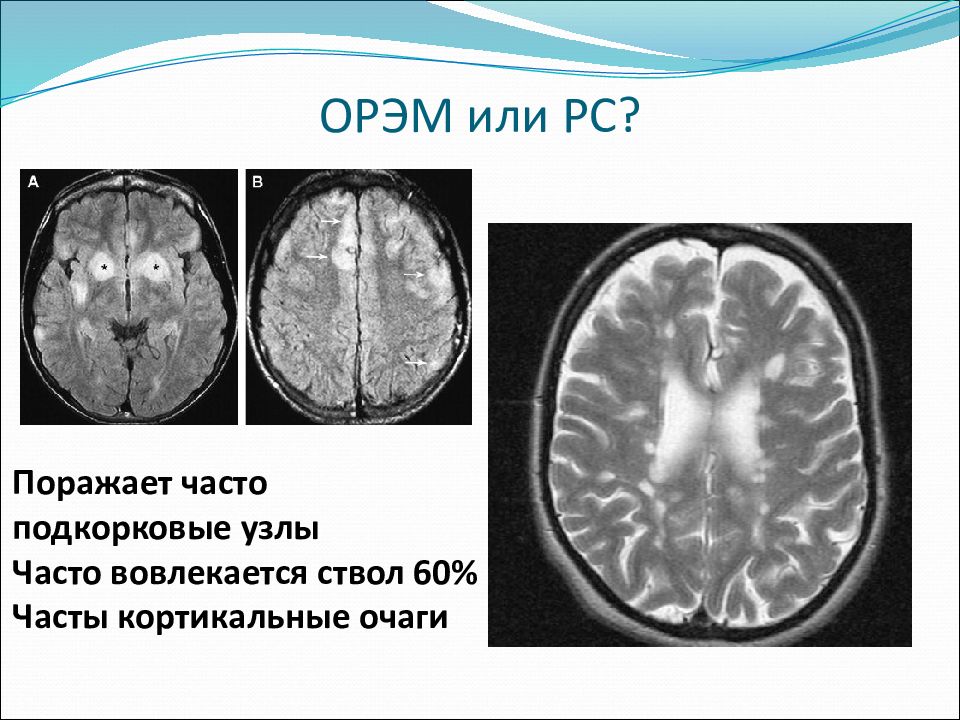 Острый рассеянный энцефаломиелит презентация