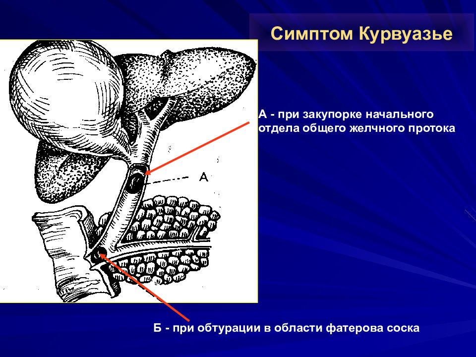 Жкб механическая желтуха карта вызова