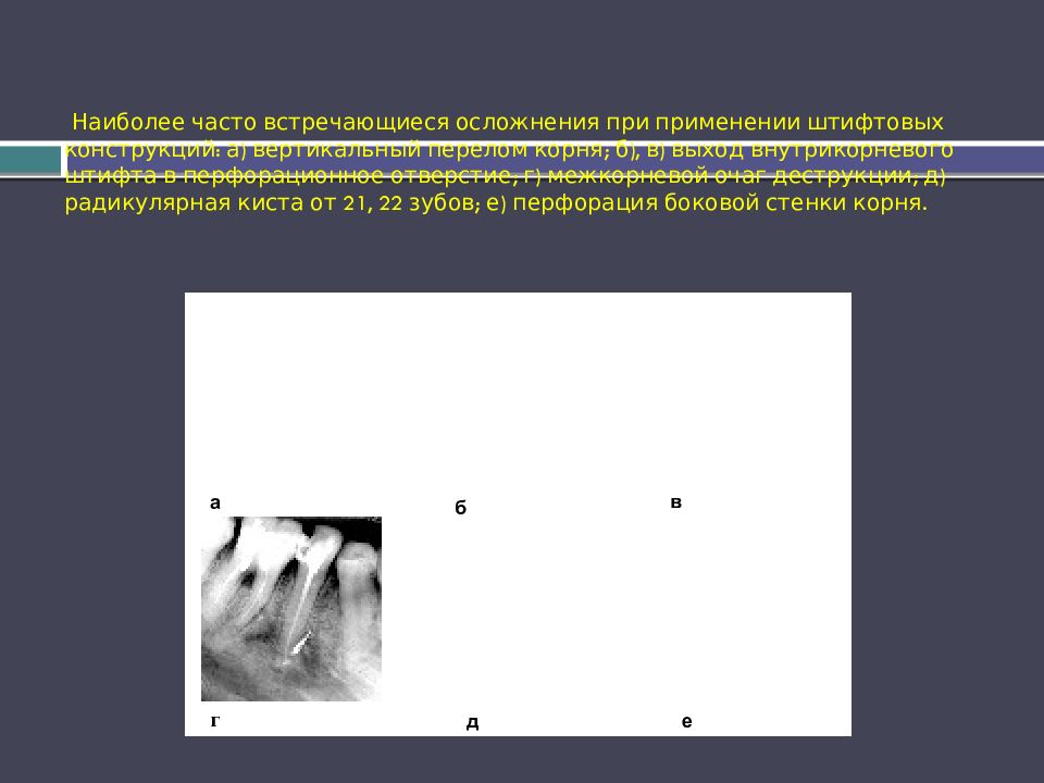Наиболее часто встречающиеся осложнения при применении штифтовых конструкций: а) вертикальный перелом корня; б), в) выход внутрикорневого штифта в