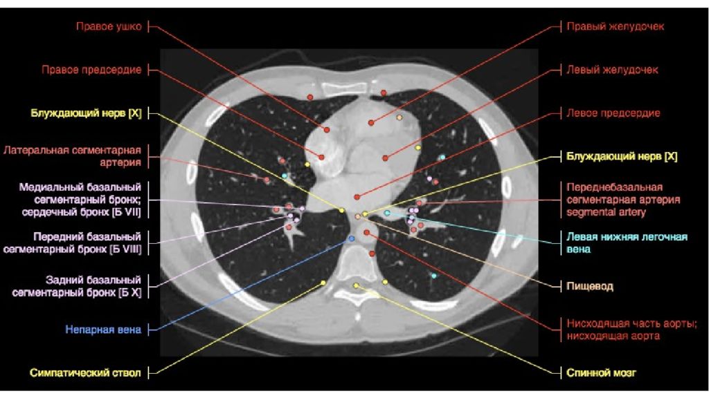 Кт клетки. Поперечный срез грудной клетки кт. Кт грудной клетки срезы аксиальные. Кт органов грудной клетки с обозначениями. Кт анатомия грудной клетки анатомические структуры.