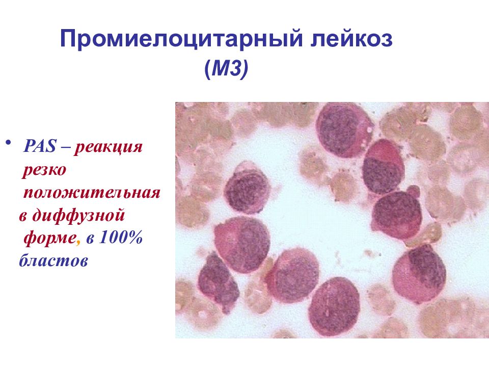 Острый лимфолейкоз презентация