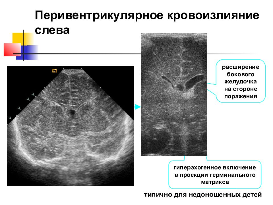 Кровоизлияние желудочка. Перивентрикулярное кровоизлияние на УЗИ. Перивентрикулярная киста на УЗИ. Перивентрикулярное кровоизлияние у новорожденных. Перивентрикулярное кровоизлияние у новорожденных 1 степени.