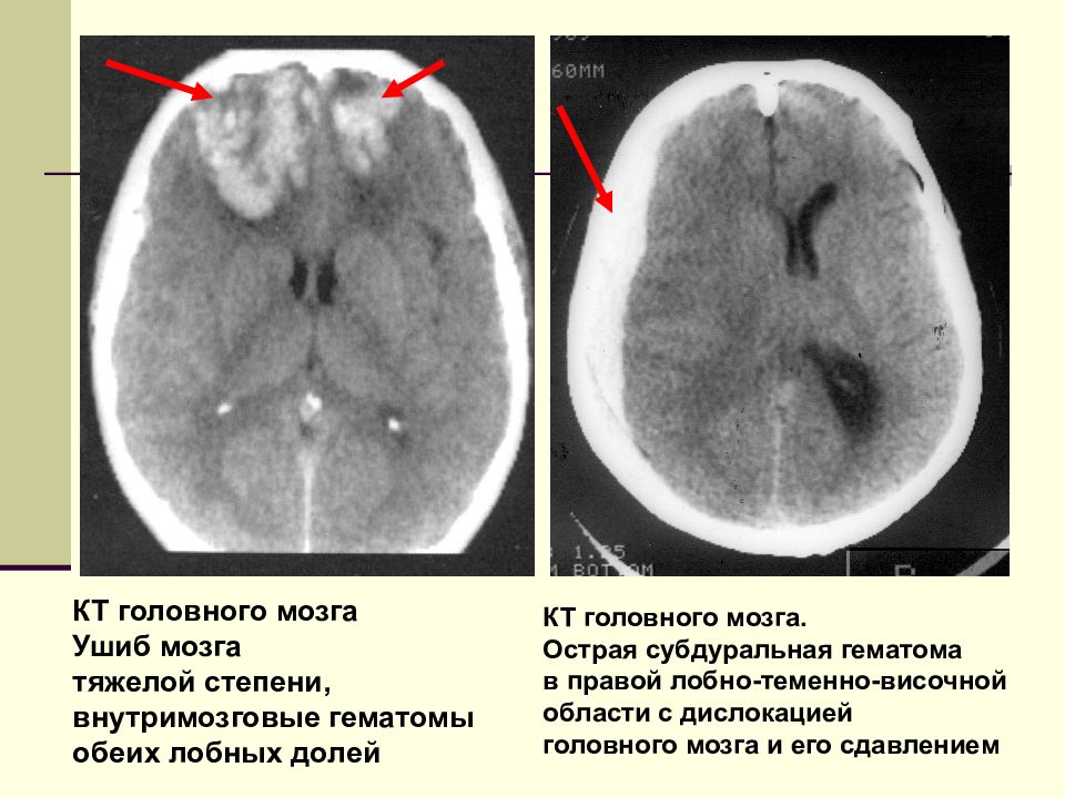 Ушиб головного мозга картинки