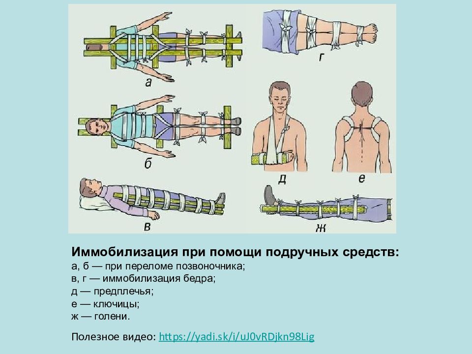 Соотнесите варианты иммобилизации показанные на рисунке с видами травм