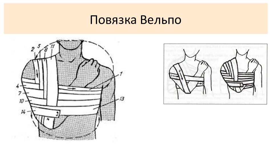 Пов это. Повязка Вельпо техника наложения. Повязки Дезо и Вельпо алгоритм. Перевязка Вельпо алгоритм. Повязка Дезо и Вельпо.