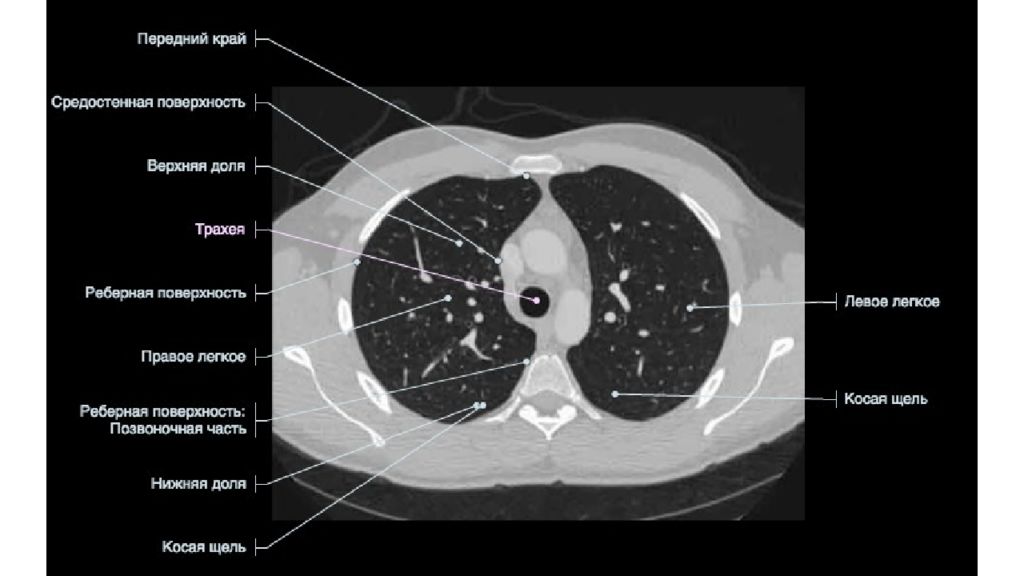 Схема легких кт