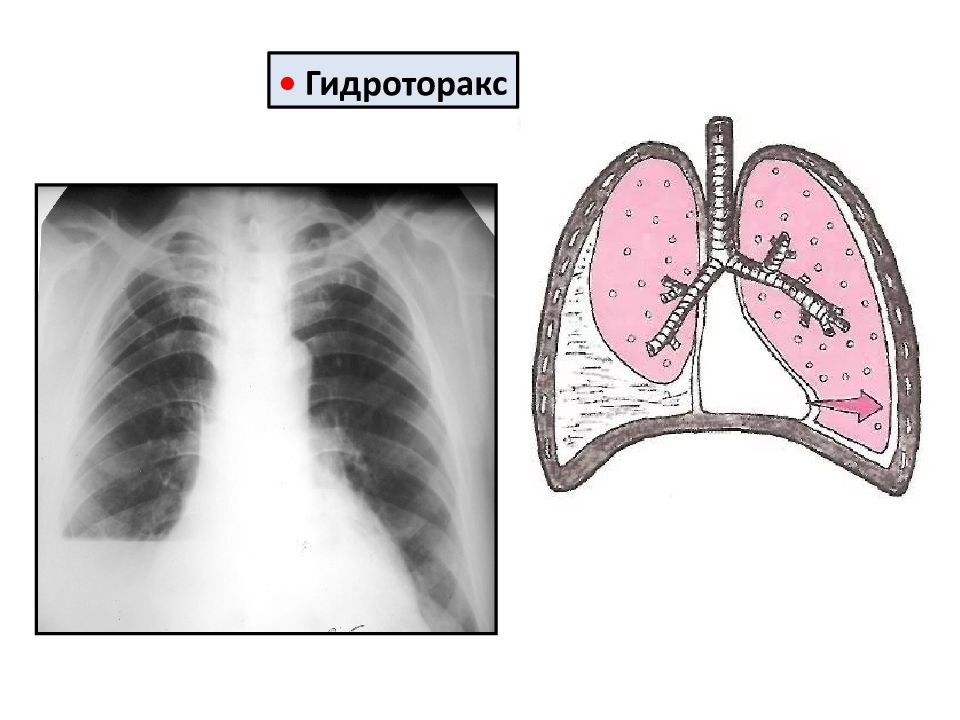 Гидроторакс аускультативная картина