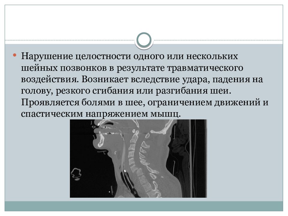 Переломы шейного отдела позвоночника презентация