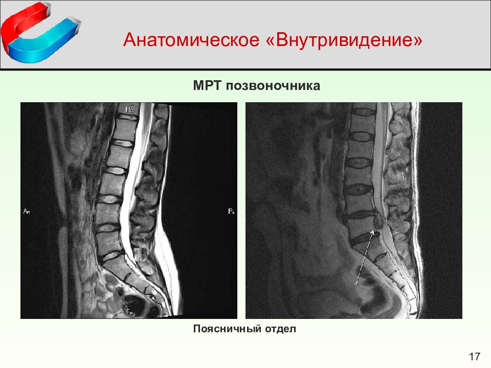 Мрт поясничного позвоночника. Мрт поясничного отдела позвоночника норма. Мрт анатомия поясничного отдела позвоночника. Деформация позвонков по типу рыбьих. Рыбьи позвонки.