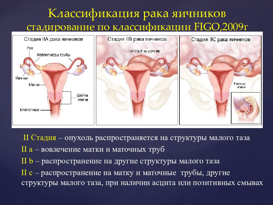 Клиническая картина рака яичников