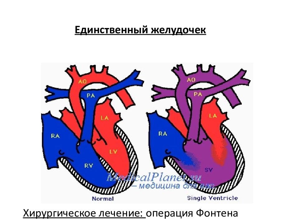 Желудочек это. Операция Фонтена гемодинамика. Врождённый порок сердца единый желудочек сердца. Операция Фонтена в модификации экстракардиального кондуита.