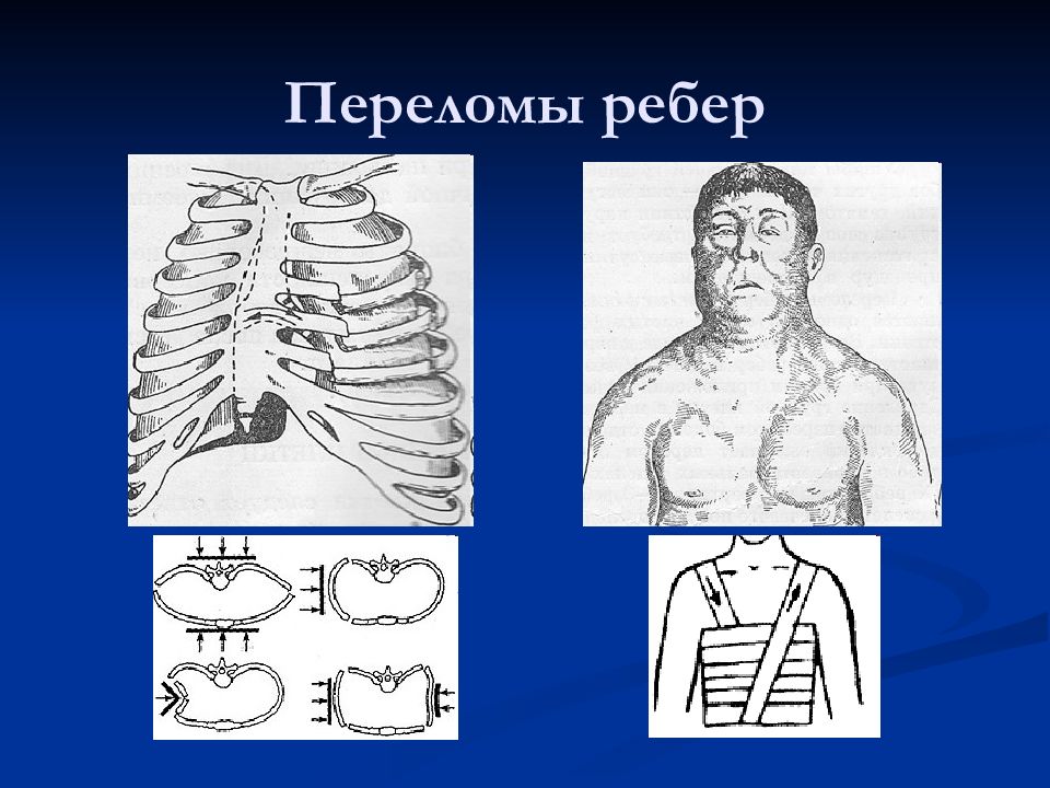 Перелом ребра карта вызова скорой