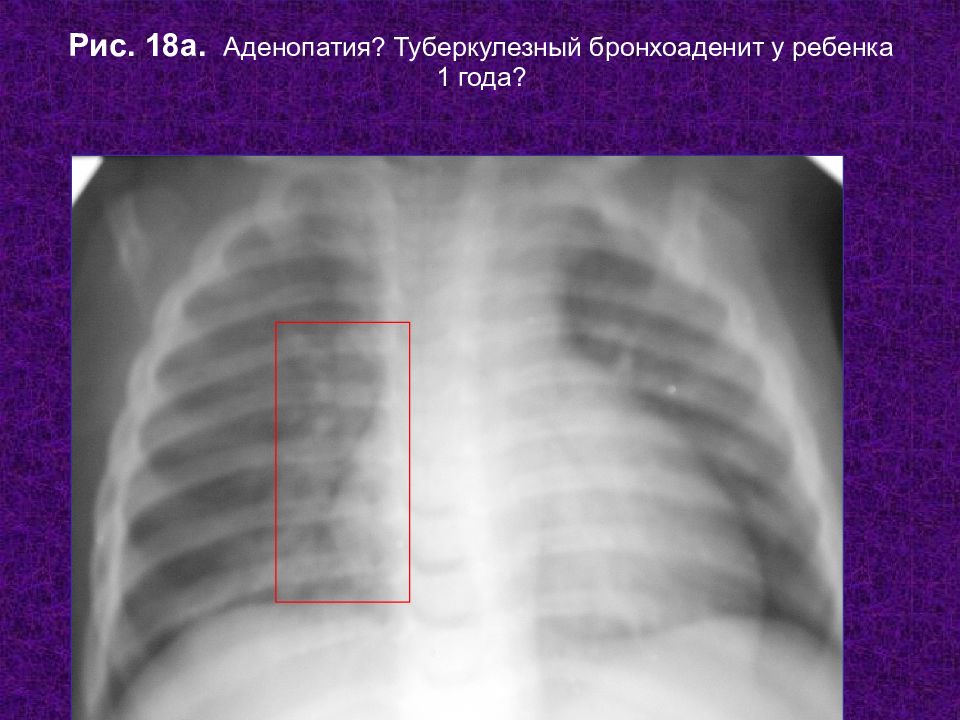 Аденопатия. Туберкулезный бронхоаденит. Туберкулёзный бронхоаденит на рентгенограмме.