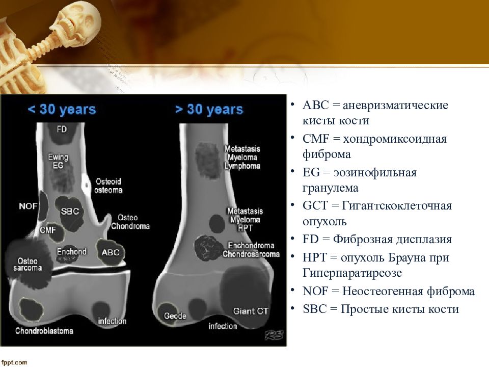 Доброкачественные опухоли костей презентация