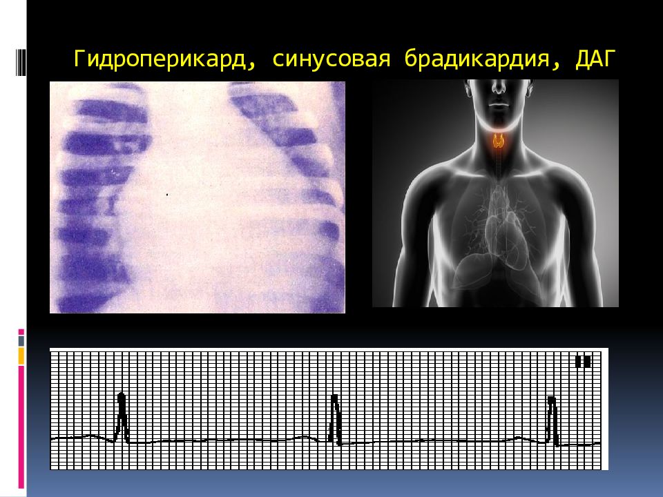 Гидроперикард. Брадикардия щитовидная железа. Щитовидка и брадикардия. Причины гидроперикарда.