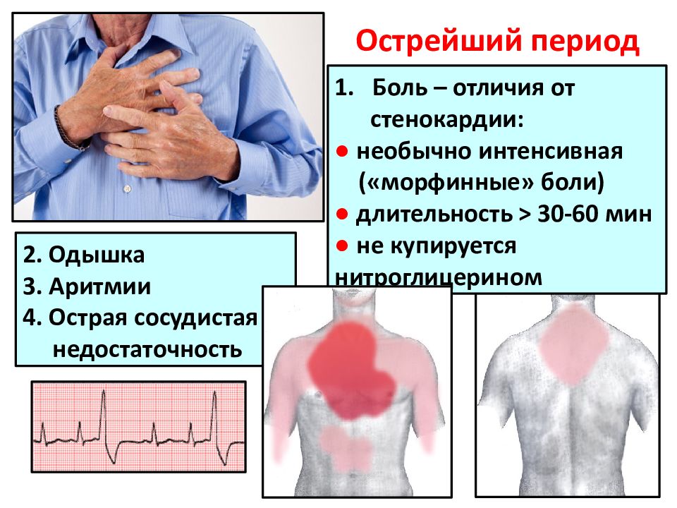 Боль при инфаркте купируется нитроглицерином. Заболевания сердца пропедевтика. Стенокардитические боли купируются. Измерение артериального давления пропедевтика внутренних болезней. Одышка пропедевтика внутренних.