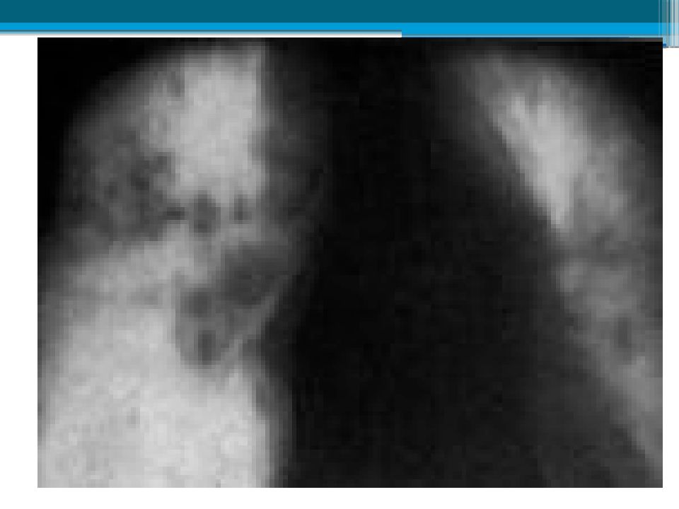 Аденопатия. Саркоидоз легочно-медиастинальная форма. Лимфогранулематоз рентгенограмма. Лимфогранулематоз рентгенологическая картина.