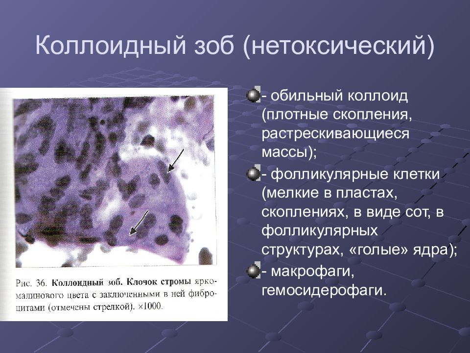 Скопление клеток фолликулярного эпителия. Коллоид щитовидной железы цитология. Узелковый коллоидный зоб. Цитограмма коллоидного зоба. Коллоидный зоб щитовидной.