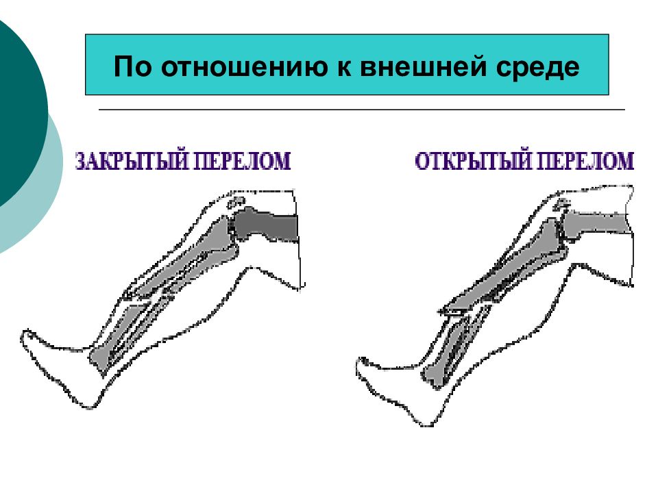 Виды переломов картинки