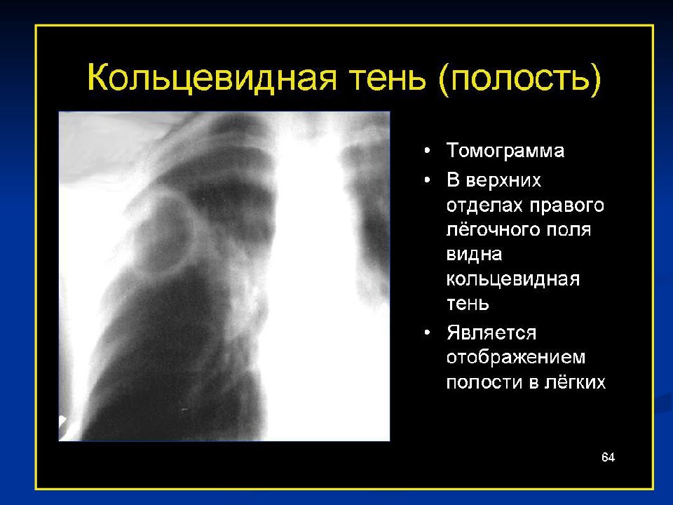 Тень в легких. Кольцевидные тени в легких на рентгене. Рентгенологический синдром кольцевидной тени. Кольцевидная тень в легком рентгенологический. Кольцевидная тень в легочном поле.